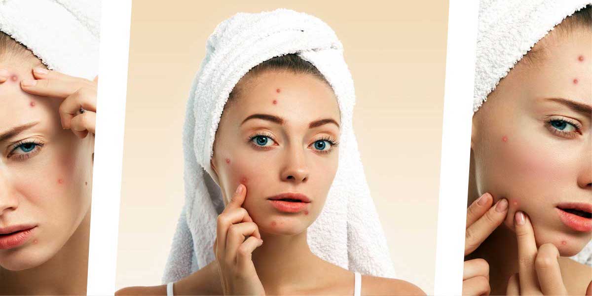 Pflegeempfehlungen bei Akne